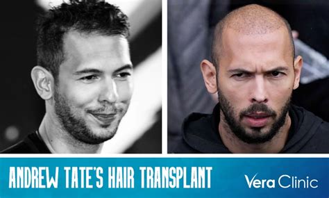 andrew tate pelo|Andrew Tate: Hair Transplant Rumours, Bio, Fame,。